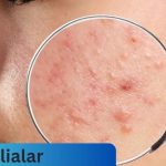 Milialar: Understanding, Treating, and Preventing Milia Skin Condition